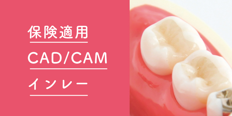 保険適用CAD/CAMインレー